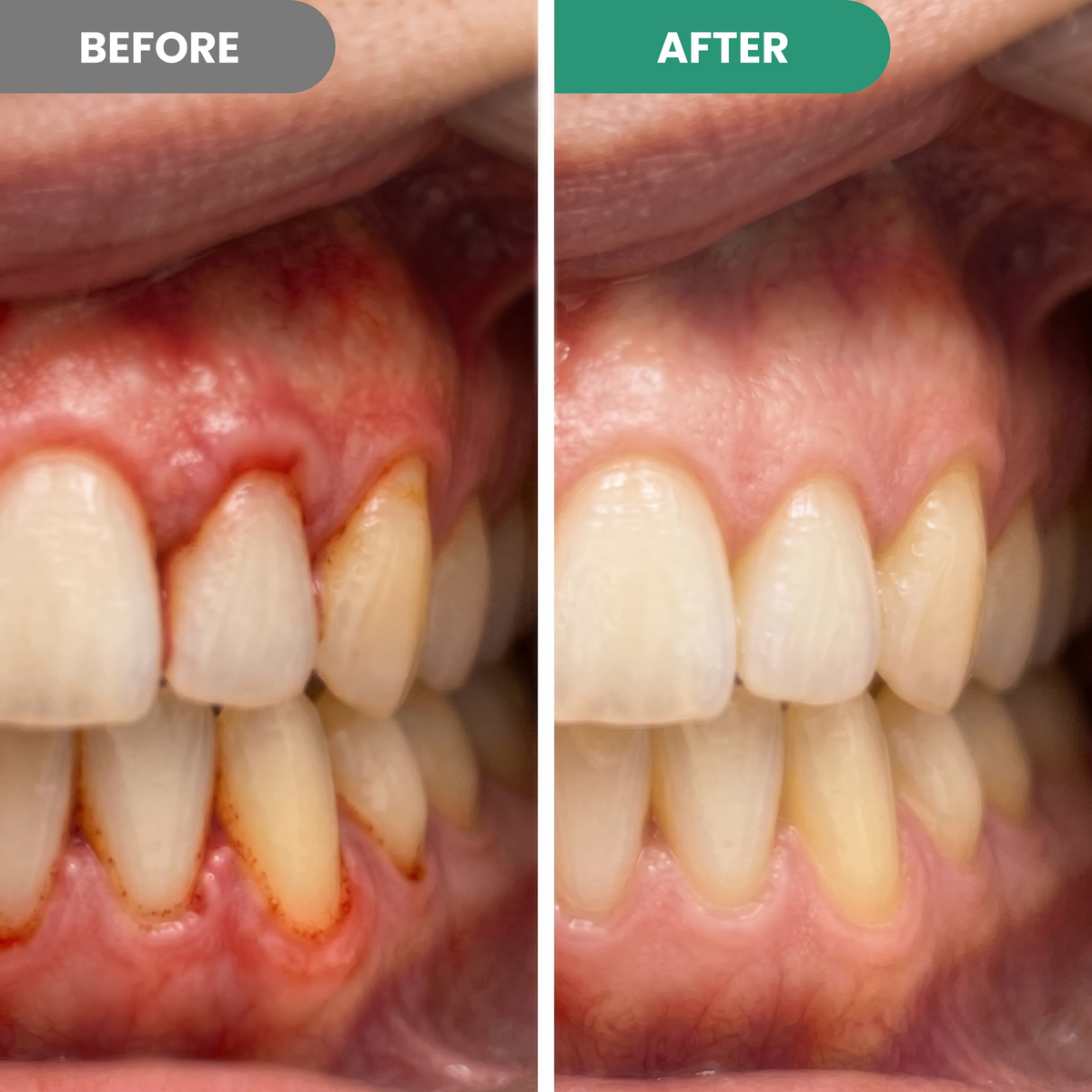Teeth Repair Gel