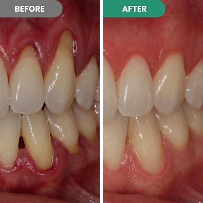 Teeth Repair Gel